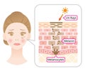 Skin mechanism of melanin and facial dark spots. Infographic illustration of woman face and skin layer. Beauty skin care concept Royalty Free Stock Photo